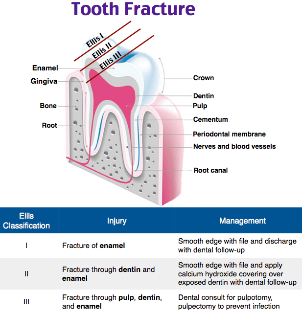 Tooth Fracture Grading