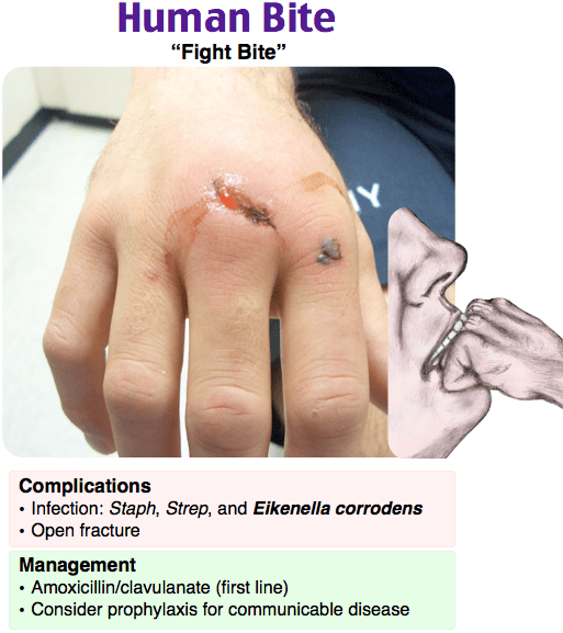 Top 105+ Pictures Human Bite Marks Pictures Latest