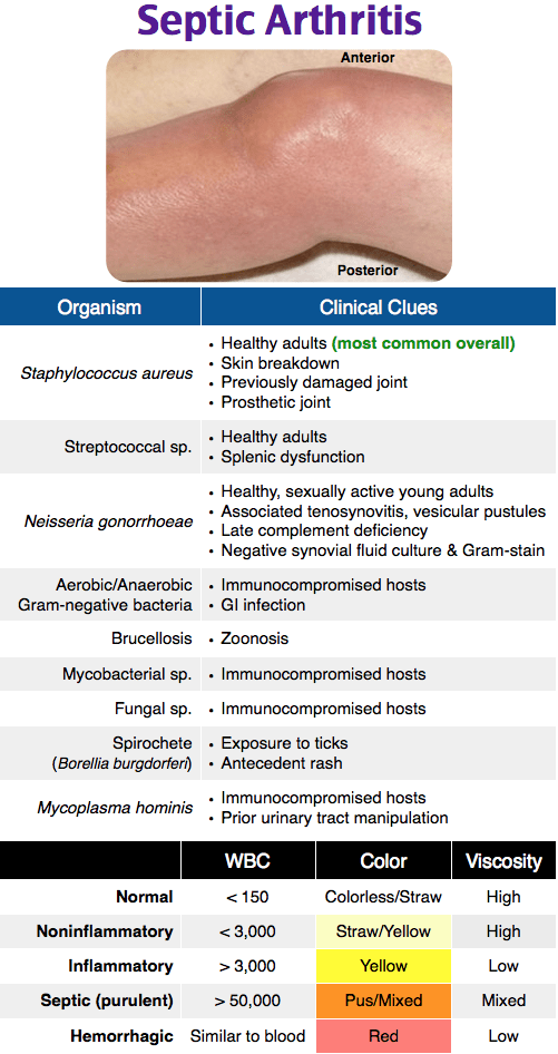 Rapid Review Septic Arthritis