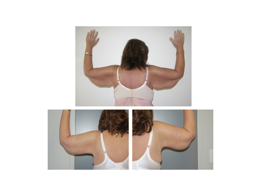 Brachioplasty Arm Lifts Runnels and North in Jackson, MS