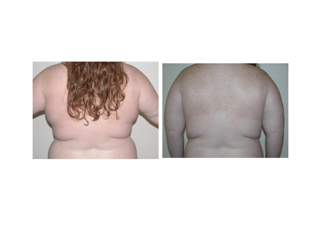 Liposuction & Liposculpture Runnels and North Outpatient Plastic