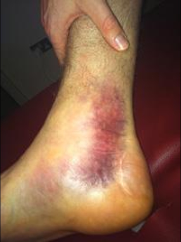 Managing Ankle Sprains RunningPhysio
