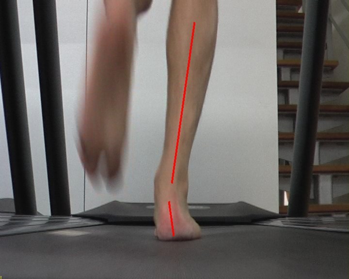 The nonsensical understanding of 'overpronation' Running Research