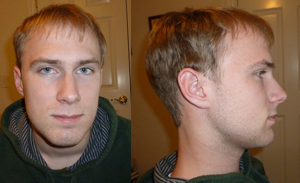 Jaw Surgery Update 3