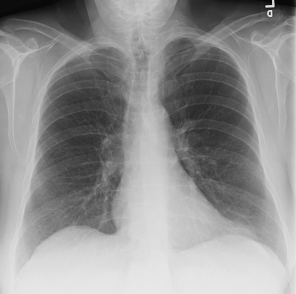 What Is Density On Chest X Ray Mean RONGAW