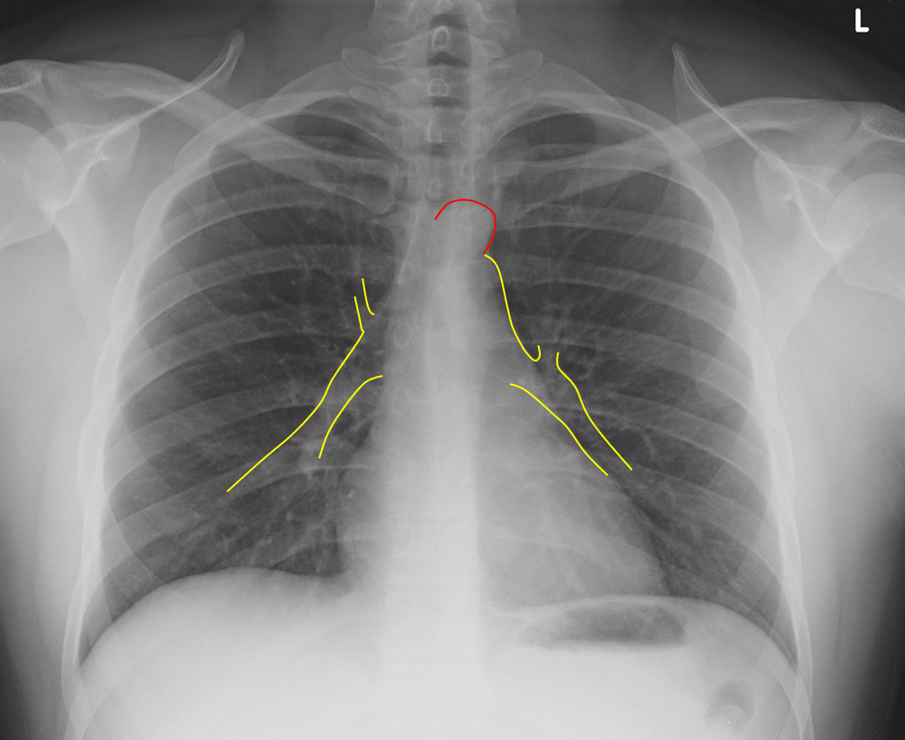 Chest Radiograph