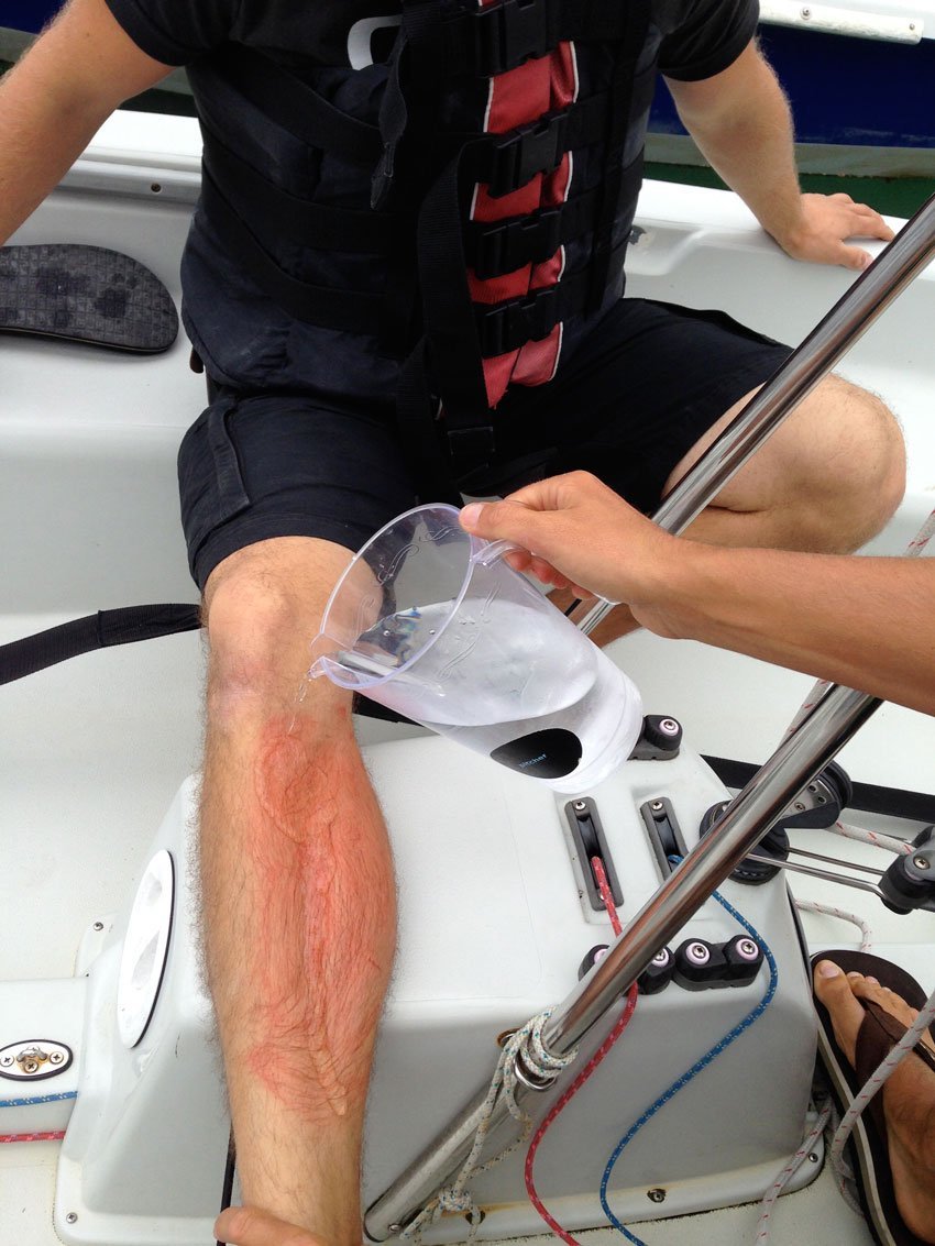 First Aid Afloat jellyfish stings Safe Skipper Boating & Safety