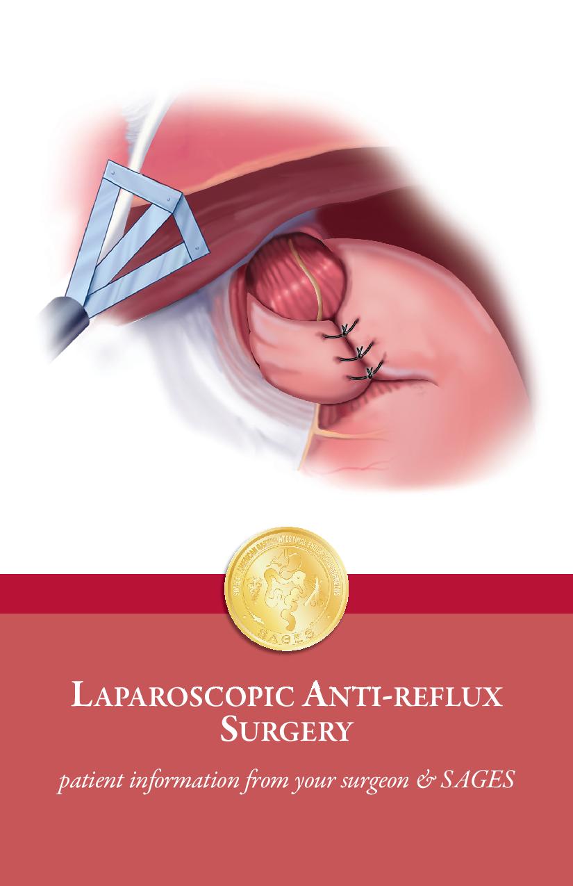 Laparoscopic AntiReflux (GERD) Surgery Patient Information from SAGES