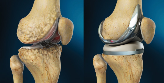 How Long Does It Take To Heal After Knee Replacement