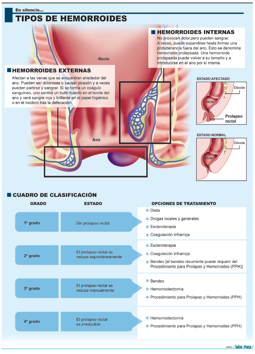 Hemorroides Sufrirlas en silencio, pero no en secreto Salud Ediciones