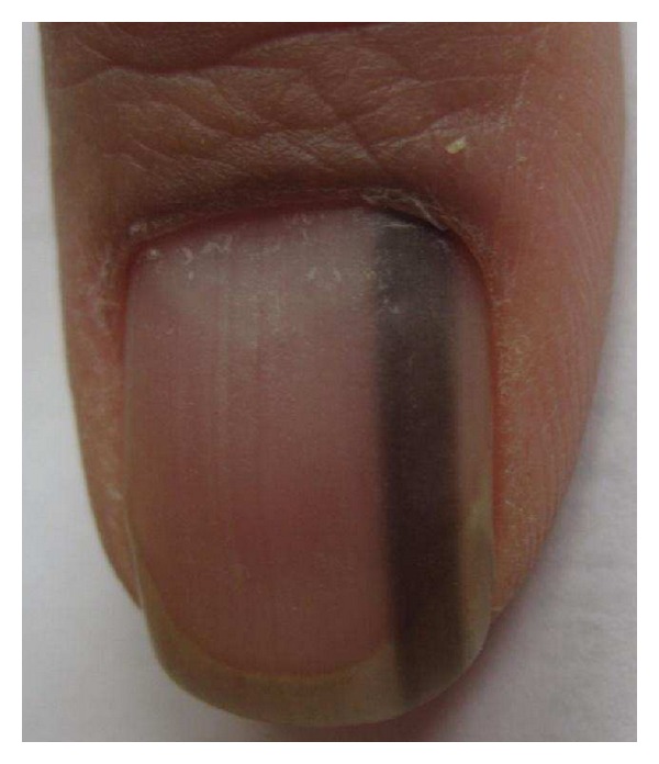 Longitudinal Melanonychia