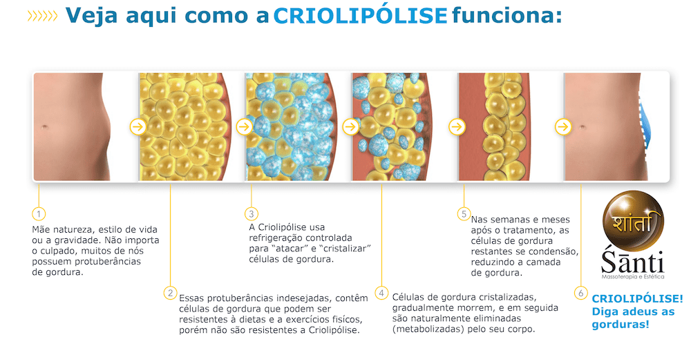Criolipólise, faça aqui! Santi Spa Massoterapia e Estética