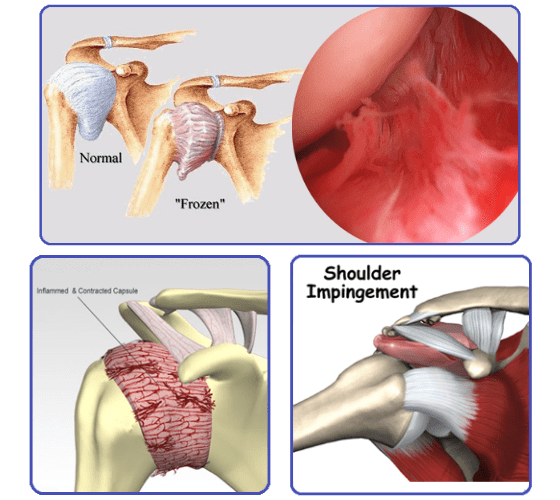 Frozen Shoulder