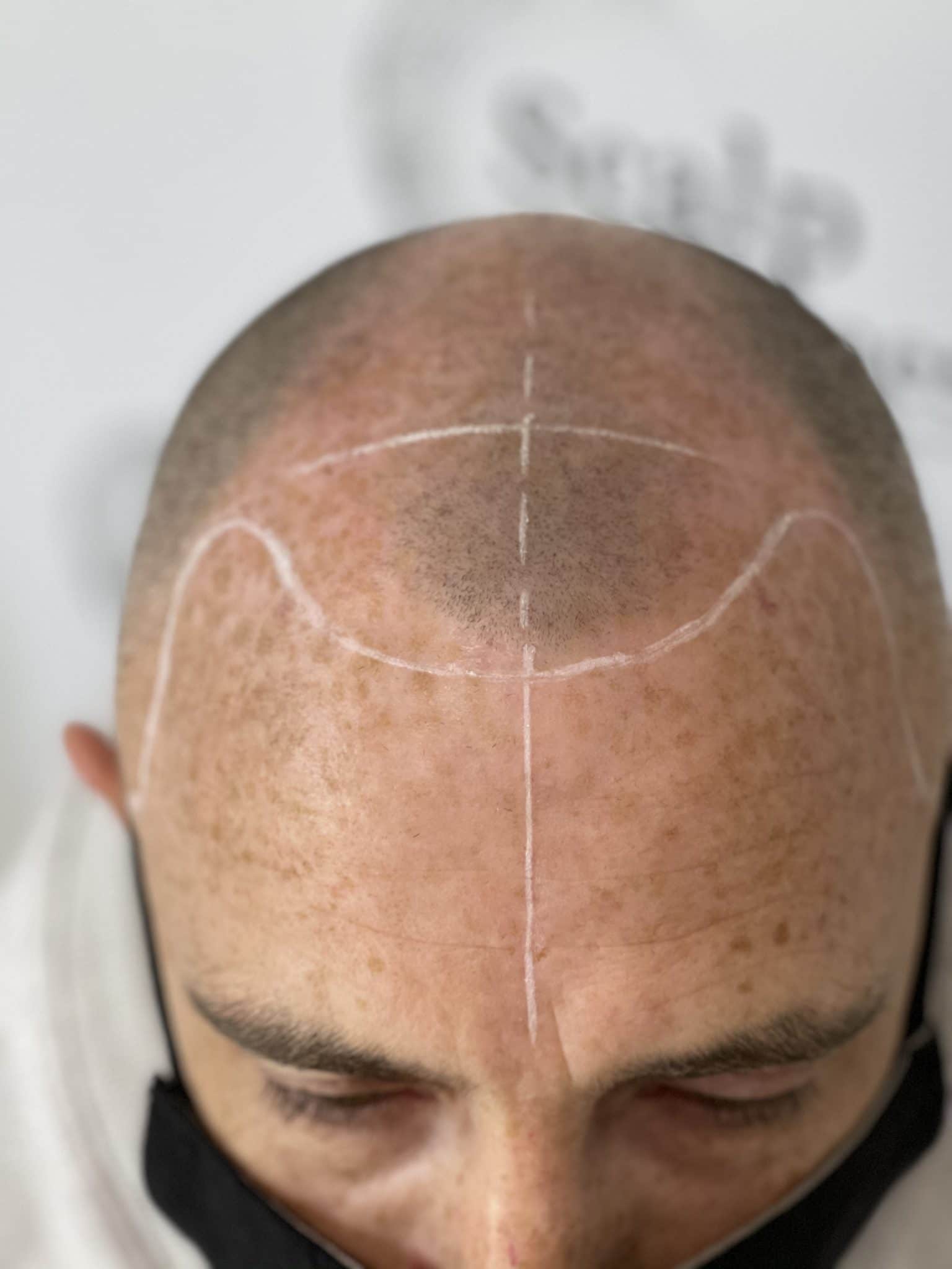 scalp micropigmentation Archives Scalp Genesis scalp micropigmentation Archives Scalp Genesis