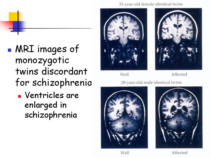 MRI Images of Brains of People with Schizophrenia