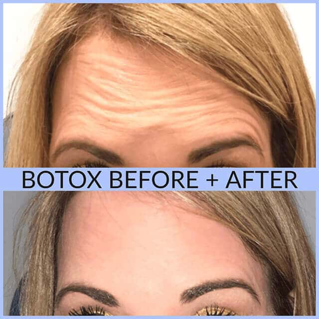 Botox Long Island Botox Before & After Schlessinger Eye