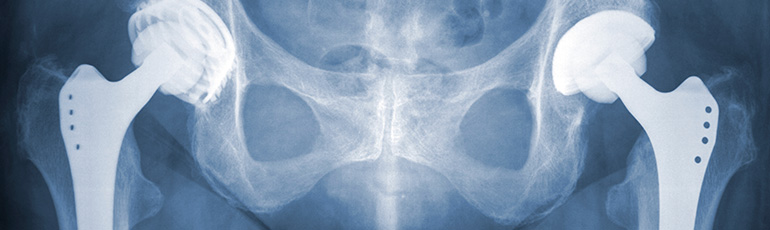 Stryker Rejuvenate Defective Medical Device Lawsuit Schmidt Kramer