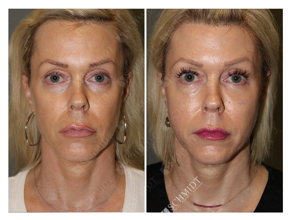 6583 Schmidt Facial Plastic Surgery