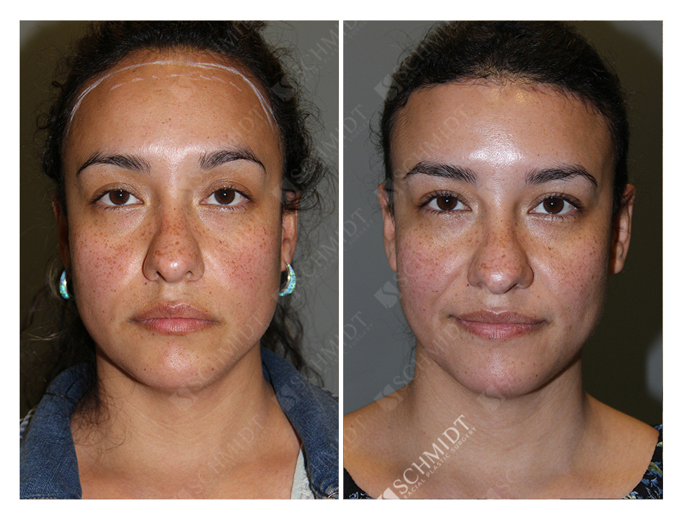 Forehead Reduction Case 6616 Schmidt Facial Plastic Surgery