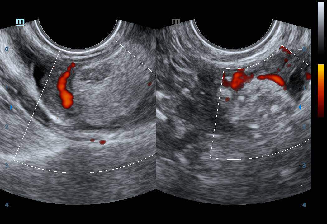 Bilateral ovarian hyperechoic lesions a surprise ScholarMD
