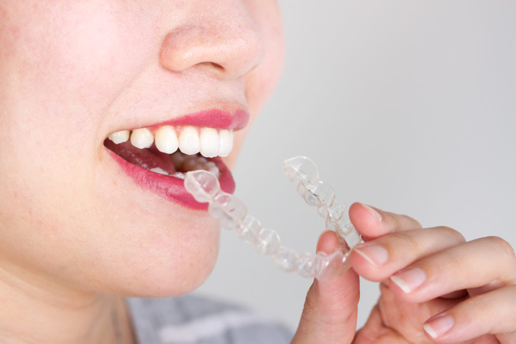 What Are Invisalign Trays Made of?