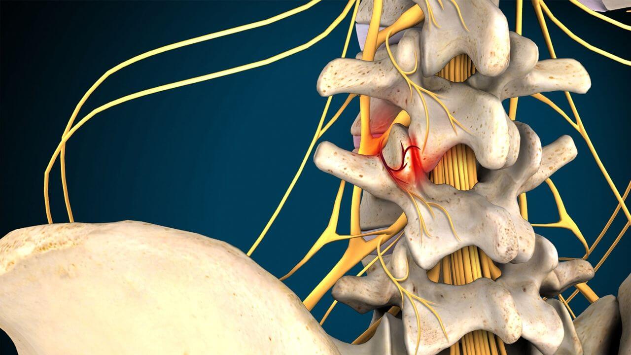 Facet Joint Syndrome Causes, Symptoms and Treatment DISC