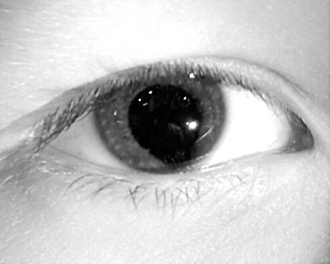 Coloboma Humans With "Cat Eyes" Science 2.0