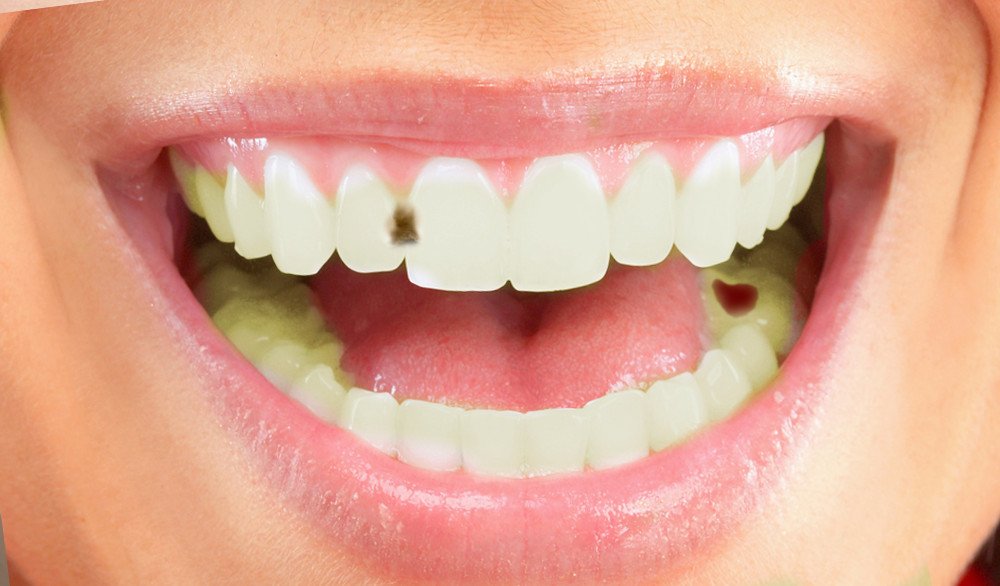 How Do Cavities Form In Teeth? » ScienceABC