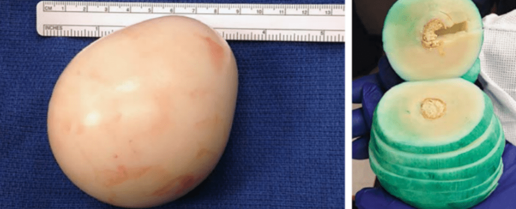 This huge rubbery mass has been floating around a man's