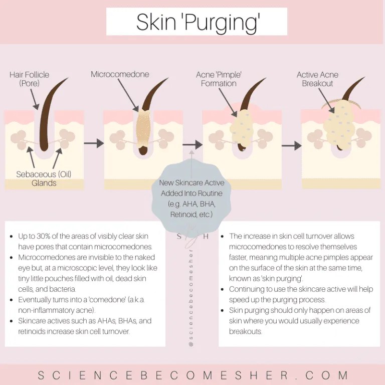 Does Azelaic Acid Cause Purging? Science Her