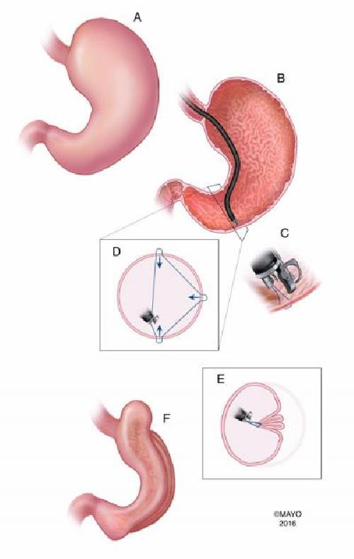 Endoscopic sleeve gastroplasty A promising new weight loss procedure Science Codex