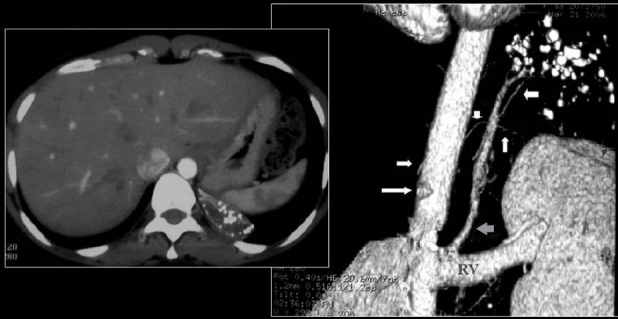 The calcified lung nodule What does it mean? ScienceOpen