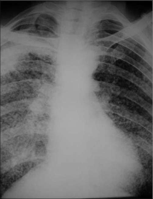 The calcified lung nodule What does it mean? ScienceOpen