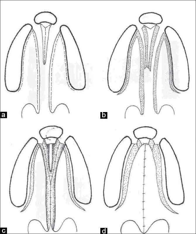 Cleft palate repair and variations ScienceOpen
