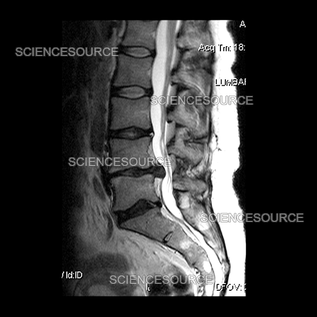 Photograph Large Lumbar Herniated Disc Science Source Images