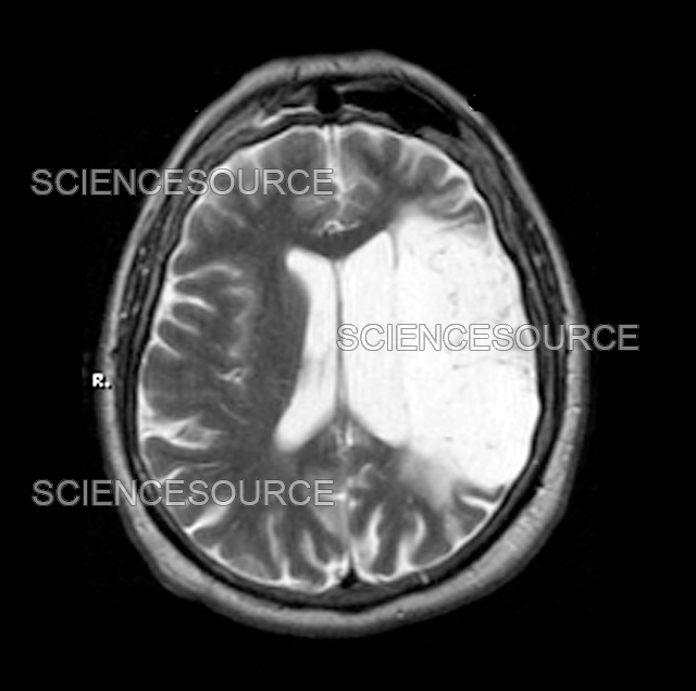 Photograph Old Stroke, MRI Science Source Images