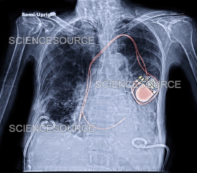 Implantable Defibrillator (Pacemaker) Stock Image Science Source Images