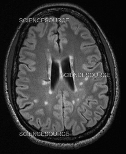 Multiple sclerosis, MRI Stock Image Science Source Images