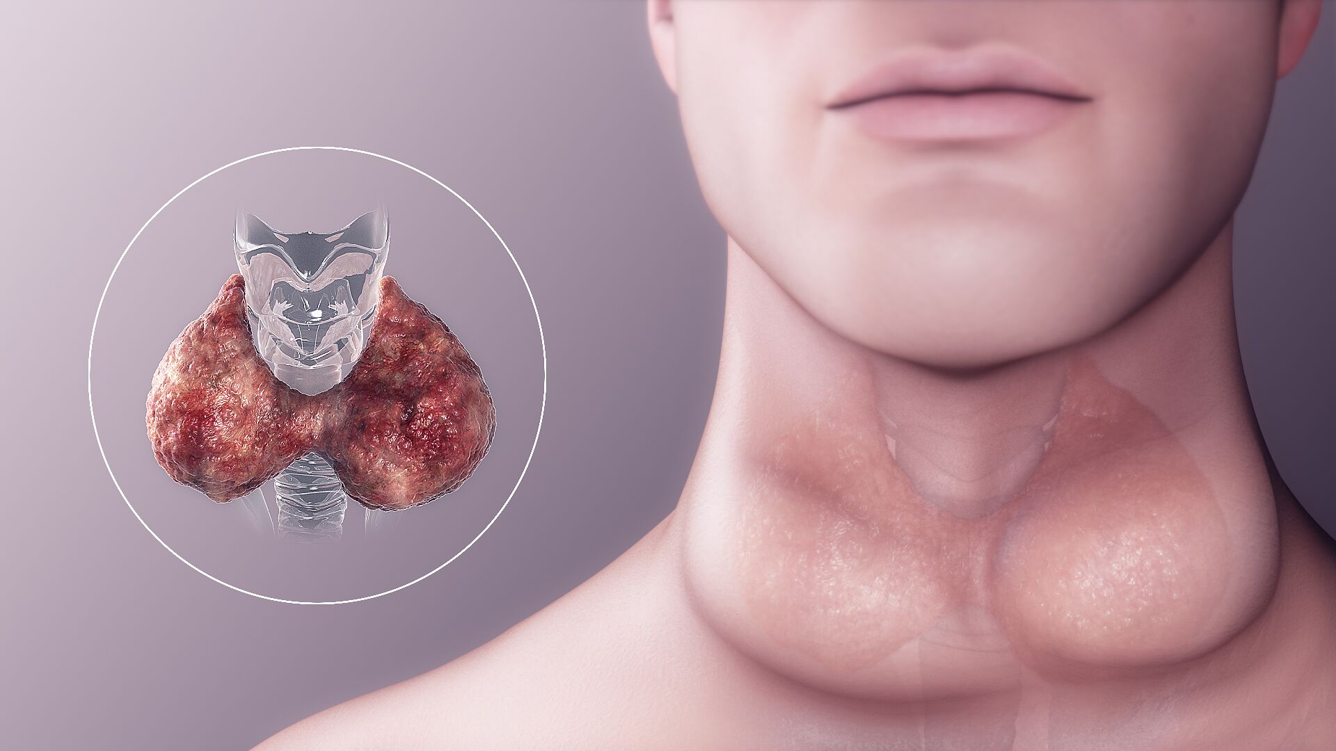Hypothyroidism Causes, Pathophysiology, Management and Treatment