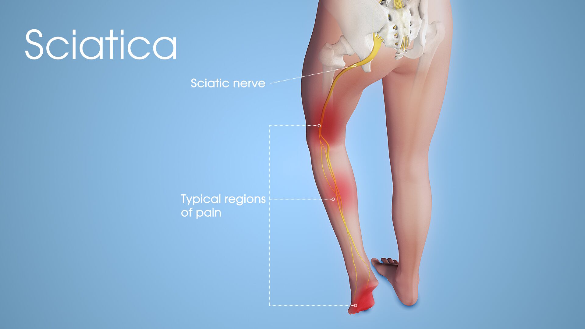 ice and heat treatment for sciatica how often Sciatica Treatment