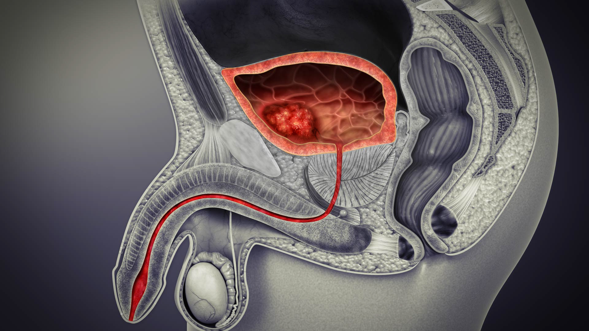 Bladder Cancer Types, Symptoms, Causes, and Treatment SA