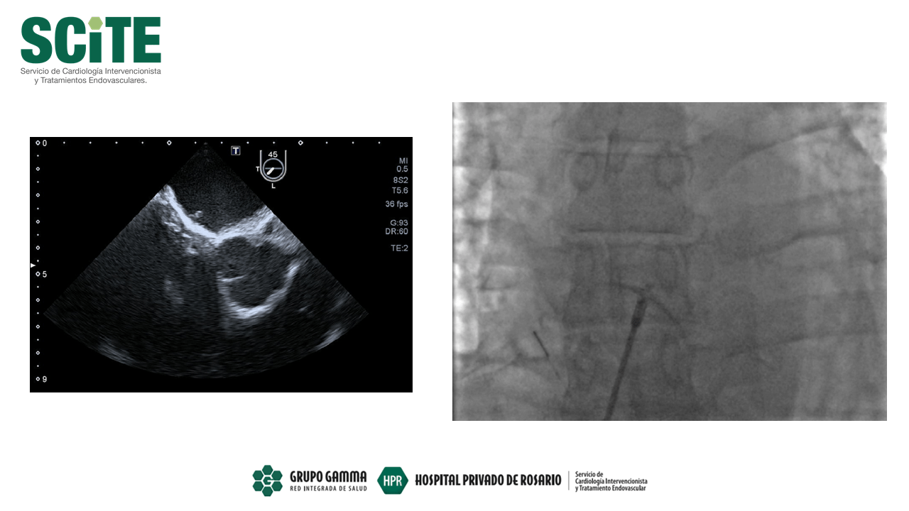Cierre endovascular de foramen oval permeable (FOP) SCITE