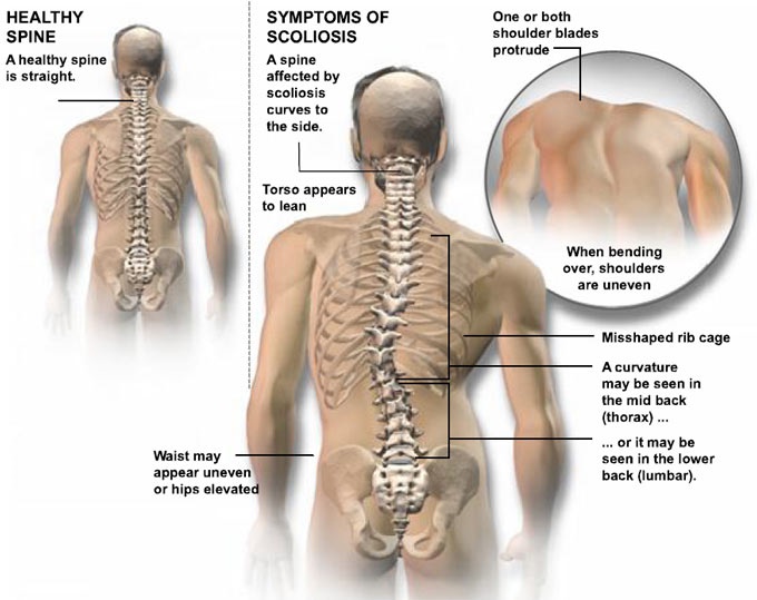 June is Scoliosis Awareness Month Scoliosis SOS