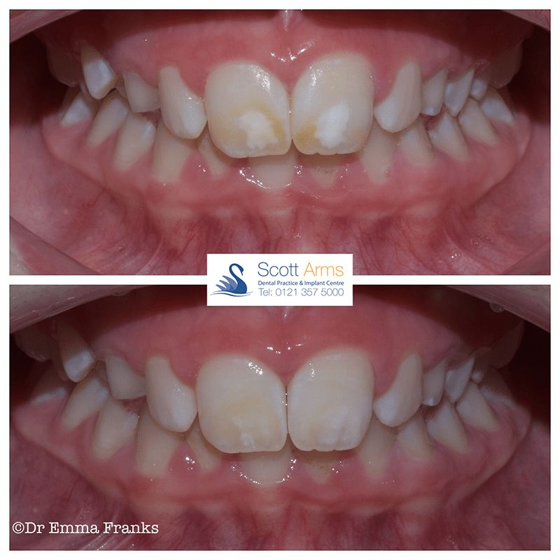 Microabrasion treatment with Dr Emma Franks Scott Arms