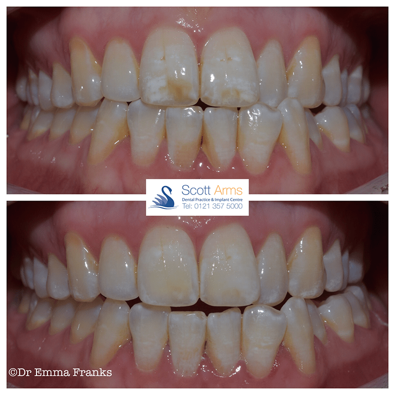 Microabrasion treatment with Dr Emma Franks Scott Arms