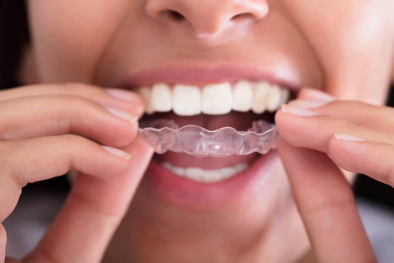 Can I Wear My Retainer After Tooth Extraction at William Nelson blog