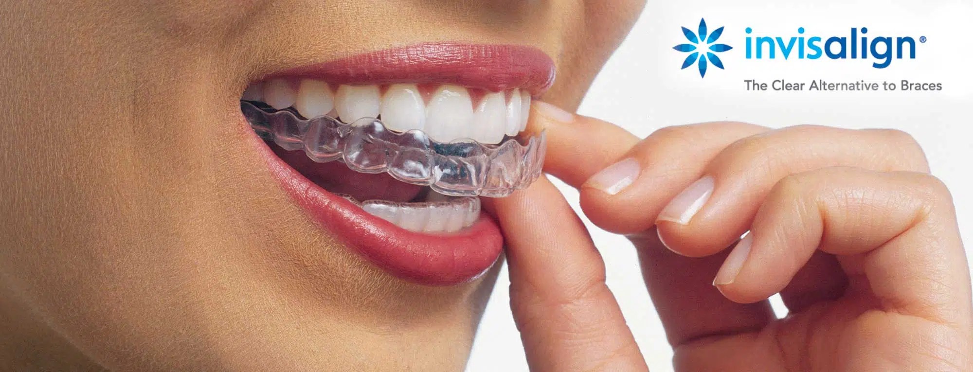 Invisalign McDonough GA Family Dentistry