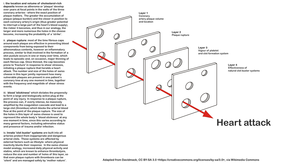 Swiss Cheese Model A Cardiologist's perspective. Surrey
