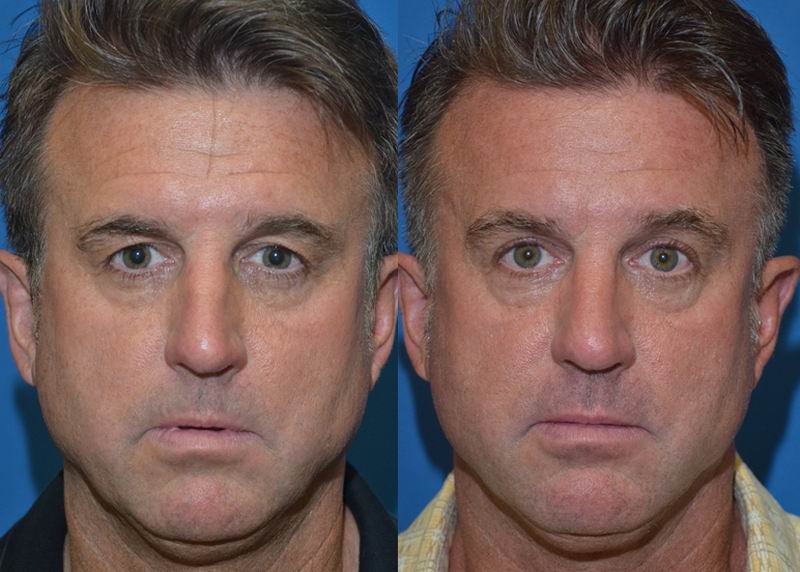 The Seattle Blepharoplasty & Eyelid Center Puget Sound RobyneEimhin
