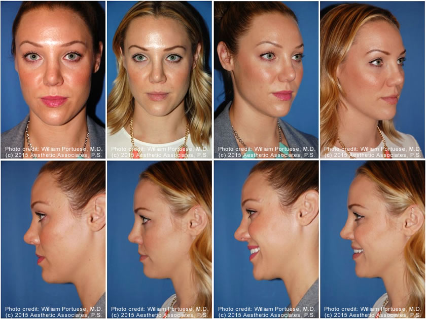 Revision Rhinoplasty in Seattle Washington